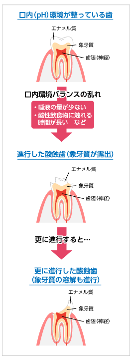 酸蝕歯の発生から進行までの図