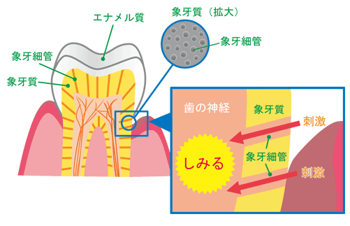 No.21 知覚過敏について | 美容・健康情報 | 全薬ヘルスビューティ・ショップ